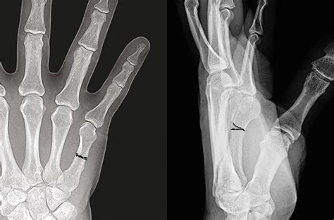 Little Metacarpal Fracture Hand Surgery Source