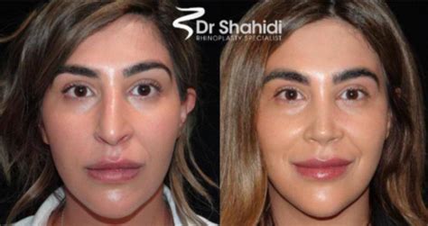 29 Year Old Mother Treated With Nose Cosmetic Surgery Pic By Dr Shahidi