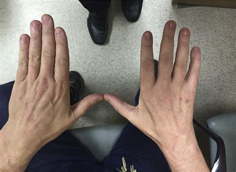 The Management Of Persistent And Recurrent Cubital Tunnel Syndrome
