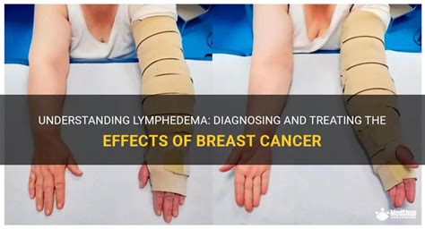 Understanding Lymphedema Diagnosing And Treating The Effects Of Breast