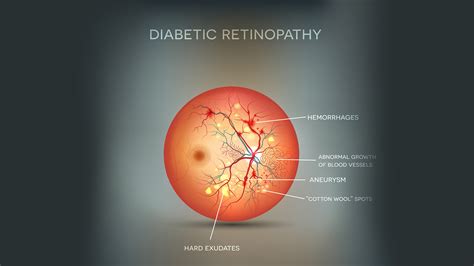 Diabetic Retinopathy Diabetes Maxivision Eye Hospital