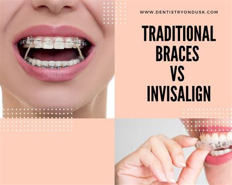 Braces Vs Invisalign Which Is Better
