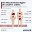 Breast Cancer Is The Most Common Form Of In Women While 