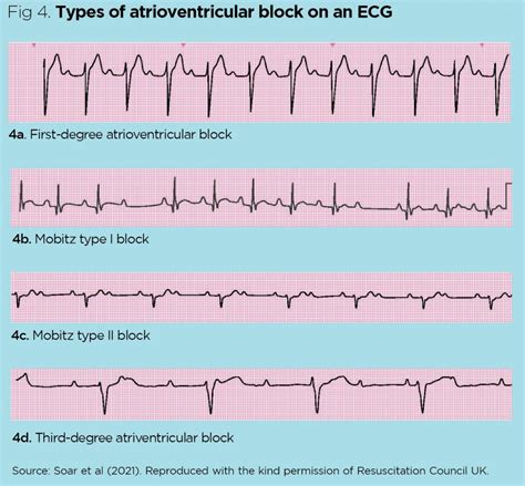 Ecg Heart Block Rhythms Four Types Of Atrio Ventricular Av Block