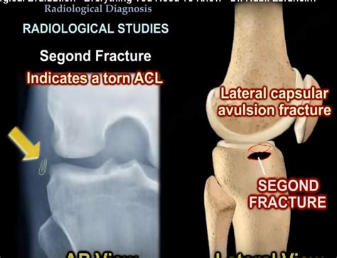 Radiological Evaluation Of Acl Tears —