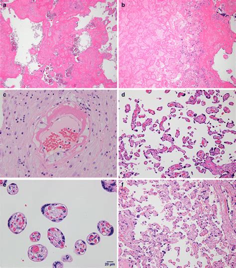 Pathological Evaluation Of Placenta Stained With Hematoxylin And Eosin