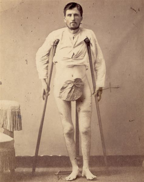 Portraits Of Injured Civil War Soldiers Cvlt Nation