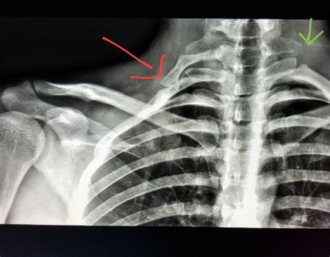 Cervical Ribs Frontal Radiograph Of The Neck Reveals Bilateral Ribs