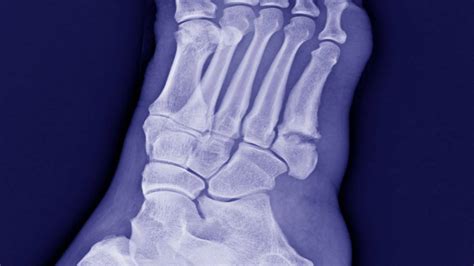5th Metatarsal Fracture Jones Fracture Dancers Foot Fracture