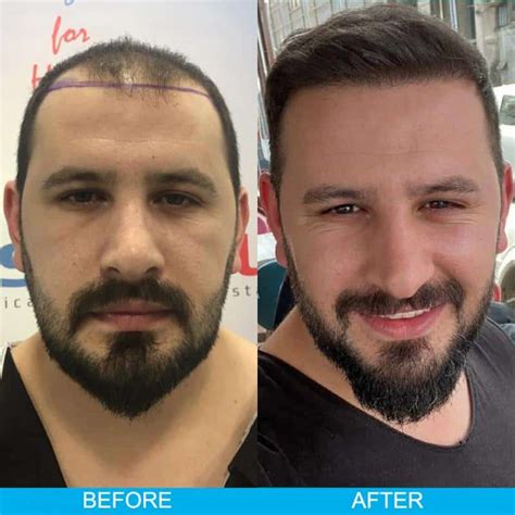 Hair Transplant Before After Results Estenbul Health