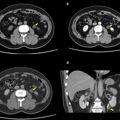 Axial Ac And Coronal D Contrast Enhanced Ct Of The Abdomen Ct