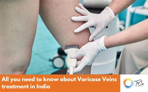 Varicose Veins Taca Healthcare Pvt Ltd