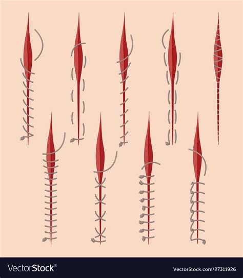 Series Of Different Medical Stitches Isolated On Vector Image