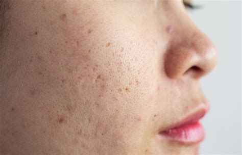 Ask A Dermatologist How To Get Rid Of Pitted Acne Scars
