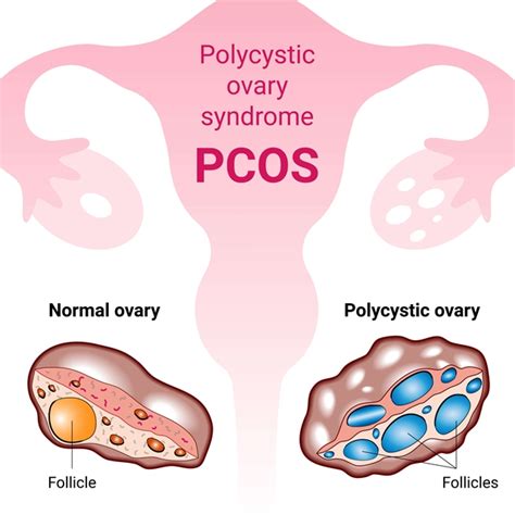 Treatment Of Polycystic Ovary Syndrome Tcm Academy