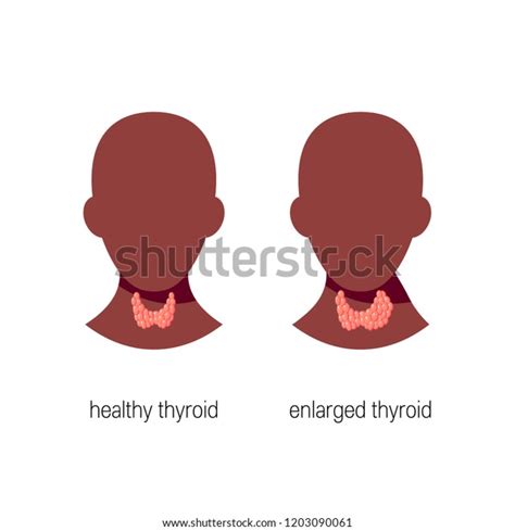 Goitre Disease Concept Vector Medical Illustration Of Healthy And