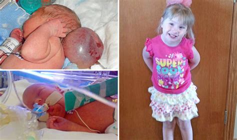Isabella Grote Born With Her Brain Growing Outside Her Skull Is Now