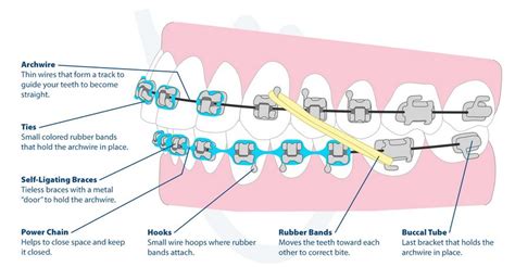 Braces For Teeth Types Cost And More On Brightpay