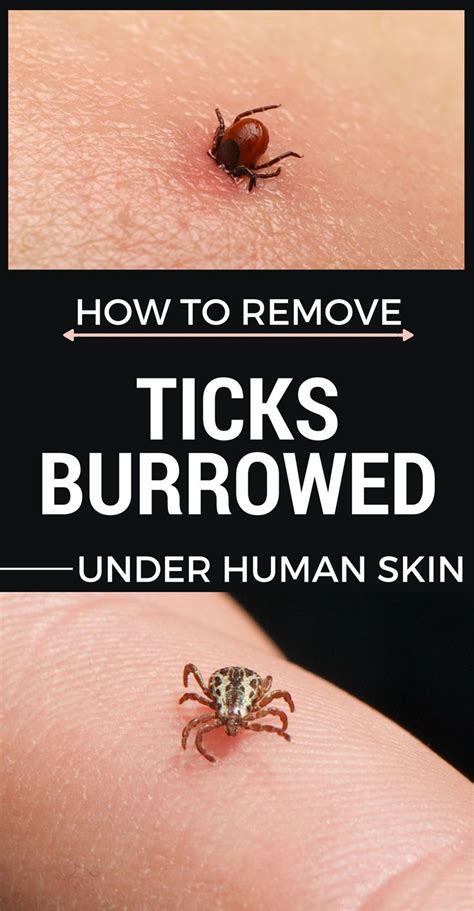How To Remove Ticks Burrowed Under Human Skin