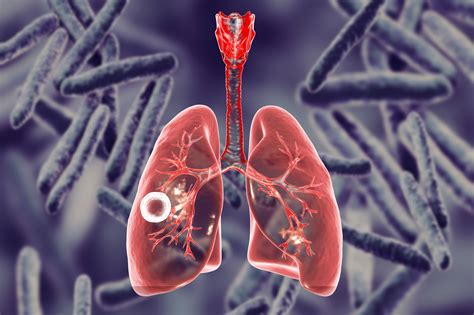 pretomanid approved as part of new regimen for drug resistant tuberculosis