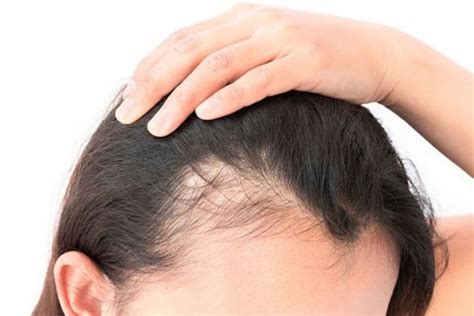 Female Pattern Baldness Symptoms Causes And More