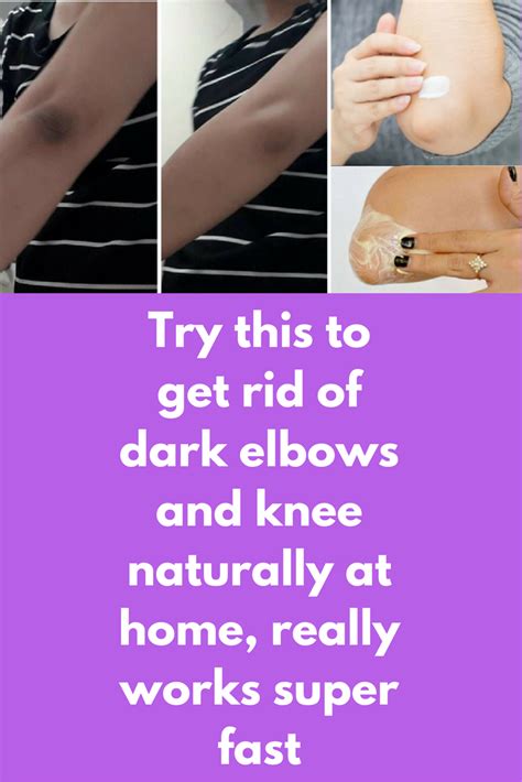 Try This To Get Rid Of Dark Elbows And Knee Naturally At Home Really