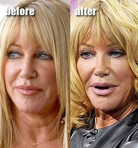 Celebrity Plastic Surgery Before After Pics Picture