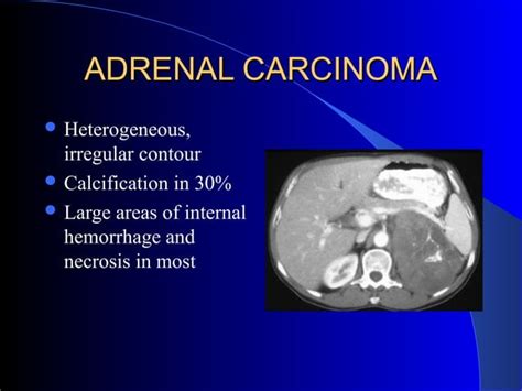 Imaging Of The Adrenal Glands Ppt