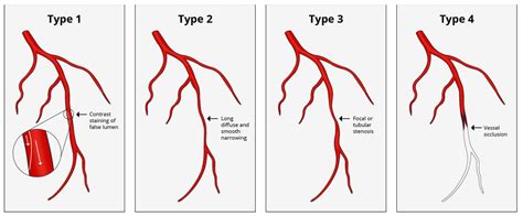 Jcm Free Full Text Spontaneous Coronary Artery Dissections A
