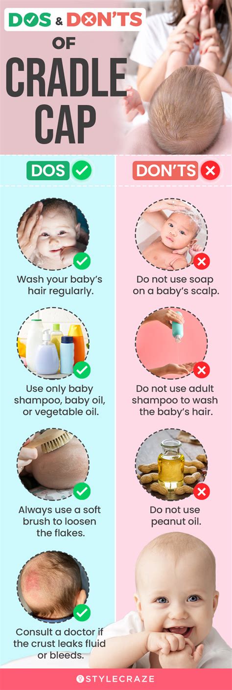 How To Get Rid Of Cradle Cap In Toddlers And Tips To Prevent It