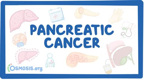 Pancreatic Cancer Clinical Sciences Osmosis Video Library