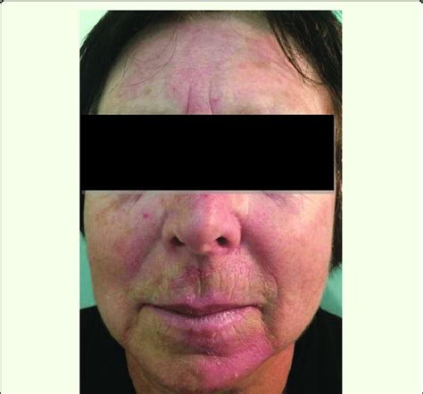 Patient N 64 Years Group Ii Diagnose Rosacea Download