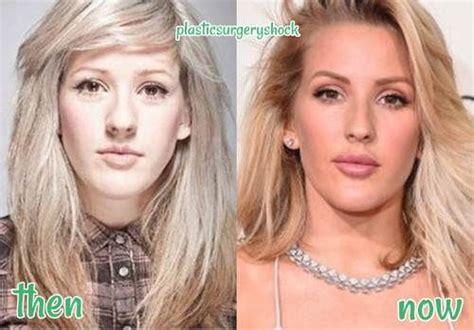 Pin On All Celebrity Plastic Surgery