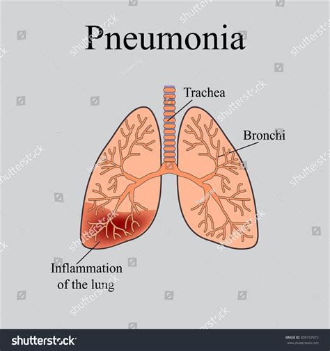 Pneumonia Anatomical Structure Human Lung Vector Stock