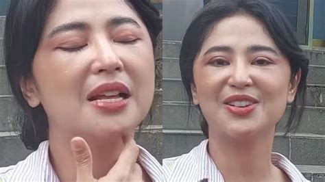 Dewi Perssik Wajahnya Nampak Berbeda Tegaskan Bukan Operasi Plastik Tapi Operasi Kesehatan Muka