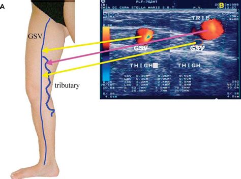Duplex Ultrasound Investigation Of The Veins In Chronic Venous Disease