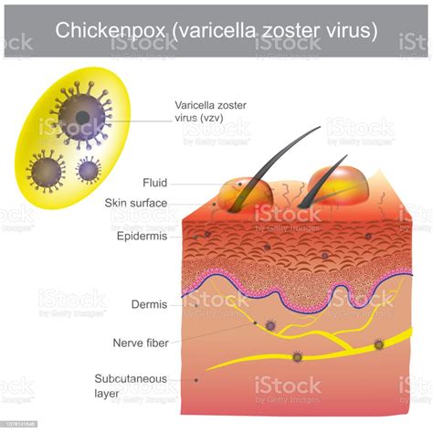 Chickenpox Varicella Zoster Virus Stock Illustration Download Image