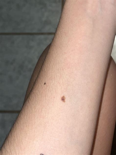 Should I Be Concerned F21 This Mole On My Arm Used To Be A Solid Dark