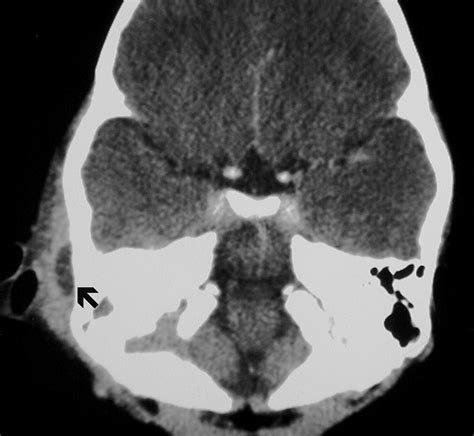 Imaging Of Complications Of Acute Mastoiditis In Children Radiographics