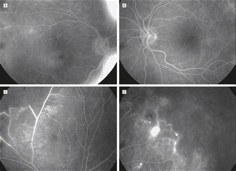 Retinal Ischemic Syndrome Digestive Tract Small Vessel Hyalinosis And
