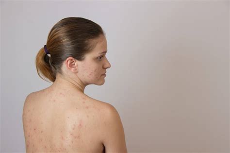 12 Home Remedies To Get Rid Of Back Acne Scars Positive Health Wellness