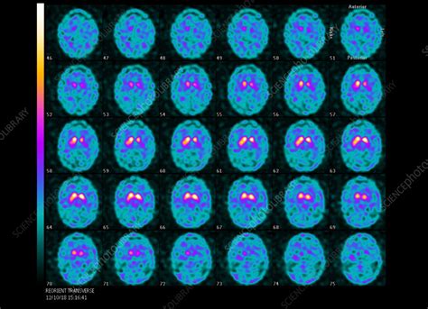 Dopamine Transporter Pet Brain Scans Stock Image C0566177