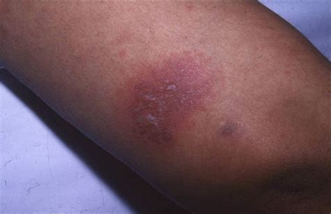 Bullous Lesions As A Manifestation Of Systemic Lupus Erythematosus In