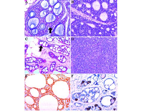 histopathological features of adenoid cystic carcinoma of the salivary download scientific