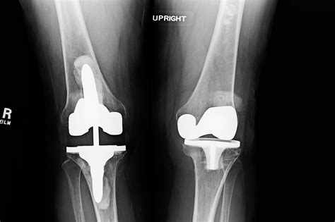 Ortho Dx Left Knee Pain Years After Total Knee Replacement Clinical