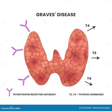 Illustration Of The Graves Disease Causes Vector Scheme Showing