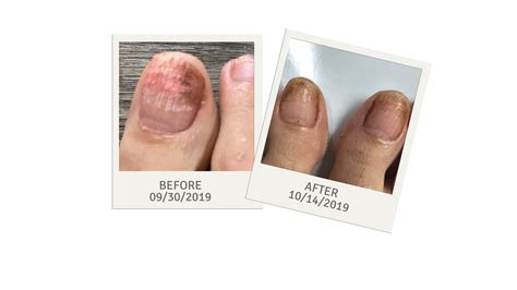 Top 146 Nail Fungus Before And After Pictures Architectures Eric
