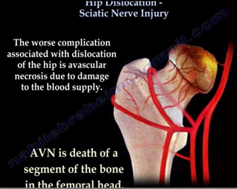 Hip Dislocation Sciatic Nerve Injury —