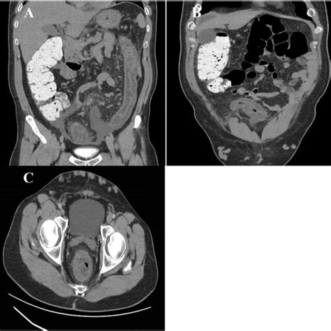 Abdomen And Pelvis Computed Tomography With Oral And Iv Contrast A