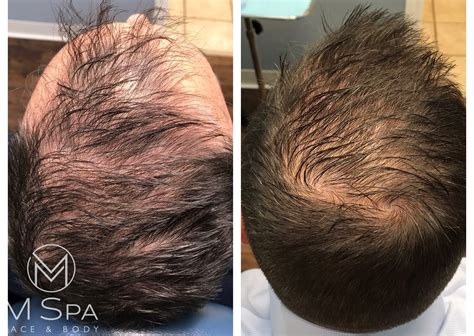 Hair Restoration With Prp Case 5 Medical Spa Houston And Webster Tx Renew Pfc